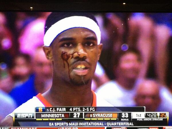C.J. Fair’s Face Gets Bloodied on His Huge Dunk